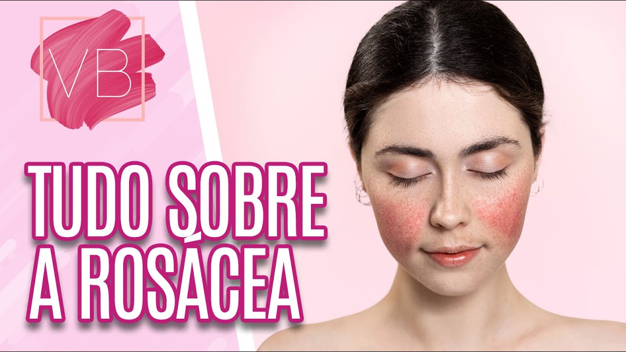 Rosácea: causas, diagnóstico e tratamentso - Você Bonita (21/03/2023)