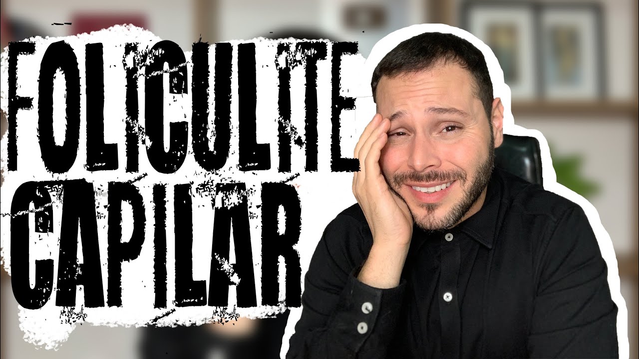 COMO TRATAR ESPINHAS NO COURO CABELUDO? #FoliculiteCapilar