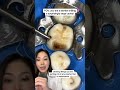 Uncovering A Surprisingly Large Cavity Cavity Drilling Dentist Bigcavity