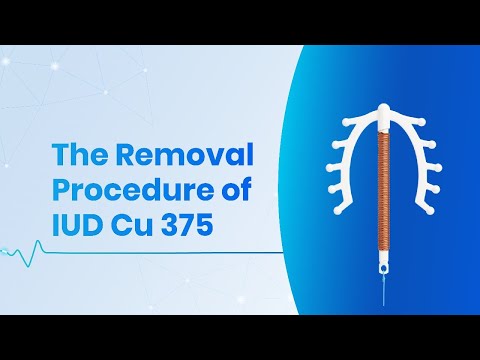 Safe and Simple SMB Copper IUD Cu 375 Removal | SMB Corporation Medical Guide