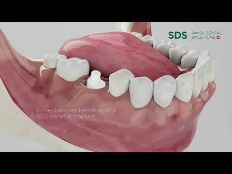 Implantacija - veiksmingiausias būdas atstatyti trūkstamus dantis, kramtymo funkciją ir estetiką.