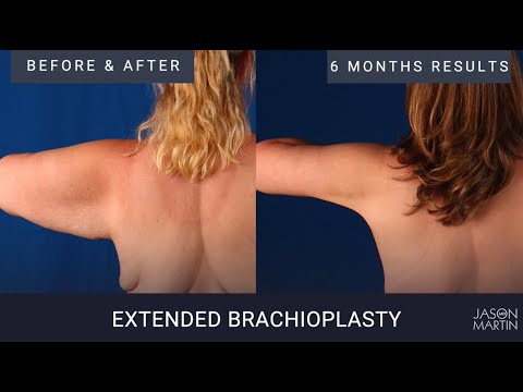 Armlift options and alternative treatments
