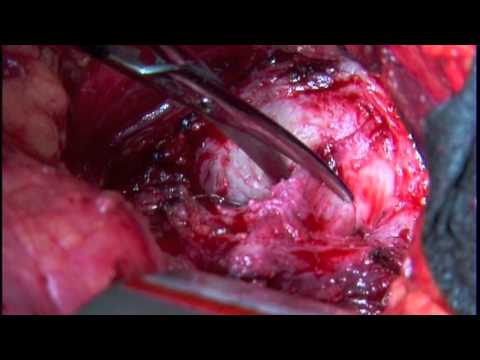 Prostata-Operation Surgut Prostata mit Land Fibrose