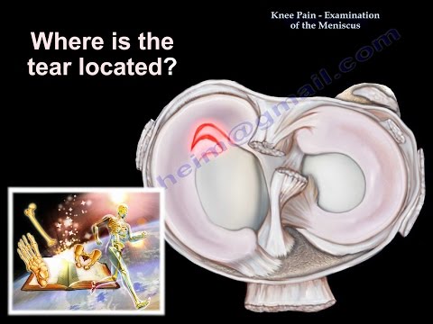 Knee Pain , Meniscus tear - Everything You Need To Know - Dr. Nabil Ebraheim