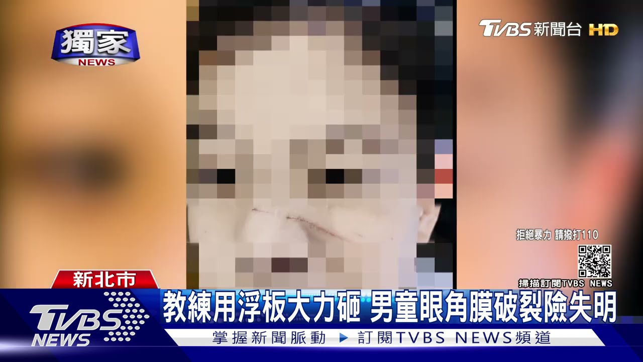 「你偷懶!」遭游泳教練砸浮板 小四男童眼角膜破裂險失明