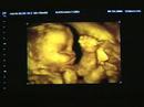 Ultrasound at 27 weeks gestation