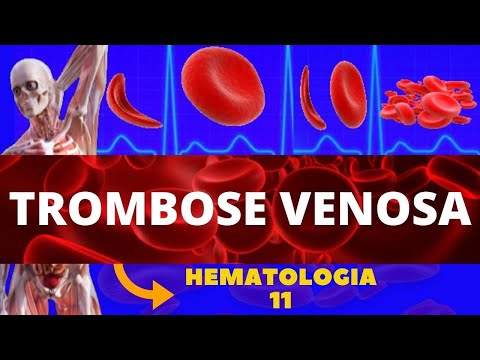 TROMBOSE VENOSA PROFUNDA (FORMAÇÃO DE COÁGULO) - HEMATOLOGIA (TVP)