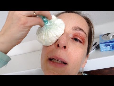 Augenlidstraffung ohne OP - Tag 0 (nach der Behandlung) Erfahrungen