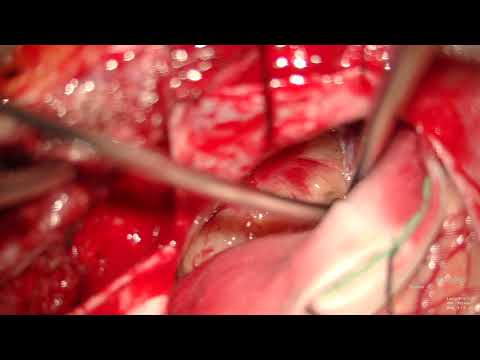 Retrosigmoid Approach To Resection Of Jugular Foramen Schwannoma