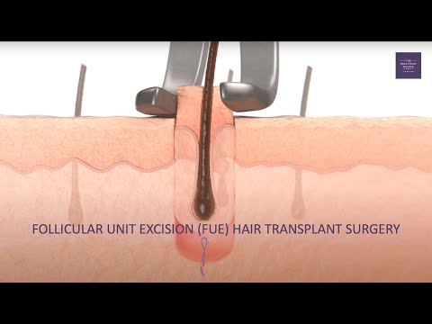 What is an FUE hair transplant?