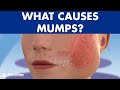 Mumps (parotitis) and other salivary glands conditions: sialadenitis, sialolithiasis, mucocele ©