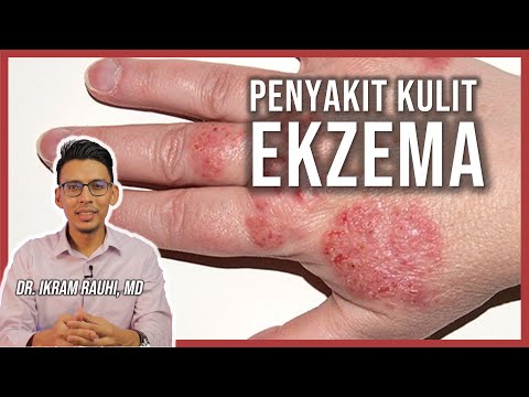 , title : 'Ekzema (Eczema) - Apa Yang Anda Patut Tahu : Punca dan Penyebab | Ubat Ekzema | Bayi dan Dewasa'