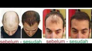 Download lagu 0815-8572-4964 | jual-minyak-kemiri-asli, minyak kemiri bekasi, jual minyak kemiri bekasi mp3 Download lagu 0815-8572-4964 | jual-minyak-kemiri-asli, minyak kemiri bekasi, jual minyak kemiri bekasi mp3