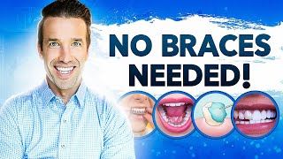 Straight Teeth Without Braces!? | Dr. Nate