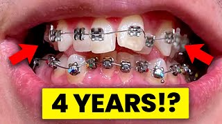 How LONG Does it take to Straighten your Teeth | McKinney Orthodontist