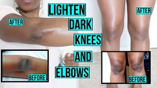 HOW TO LIGHTEN DARK KNEES AND ELBOWS FAST AND NATURALLY