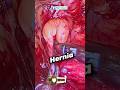 REAL HERNIA In REAL LIFE Kaisa Dikhta Hai Operation Ke Time HERNIA HOLE I ACTUAL HERNIA DEFECT SIZE