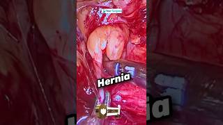 REAL HERNIA In REAL LIFE kaisa dikhta hai ?operation ke time HERNIA HOLE I ACTUAL HERNIA DEFECT SIZE