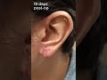Ear Lobe Repair Transformation