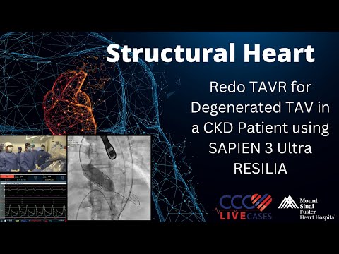 Redo TAVR for Degenerated TAV in a CKD Patient using SAPIEN 3 Ultra RESILIA