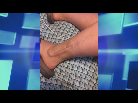 Old Scars: The Best Treatment Options