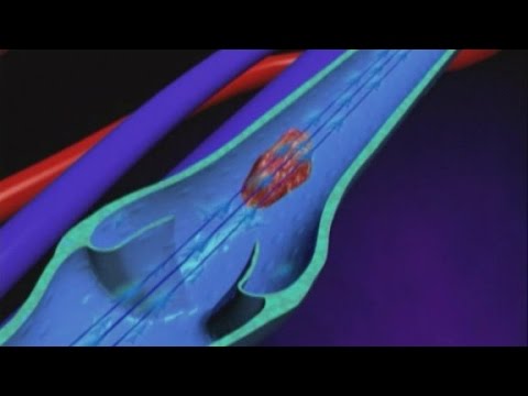 What is a blood clot? - YouTube