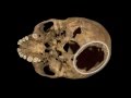 Richard III - Injuries to the Remains - YouTube