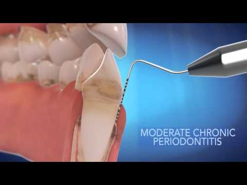 download lagu mp3 mp4 Crooked Teeth, download lagu Crooked Teeth gratis, unduh video klip Crooked Teeth