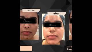 Dr Suruchi Puri Signature Skin Treatment For Acne & Acne Marks | Facial Acne | #Shorts