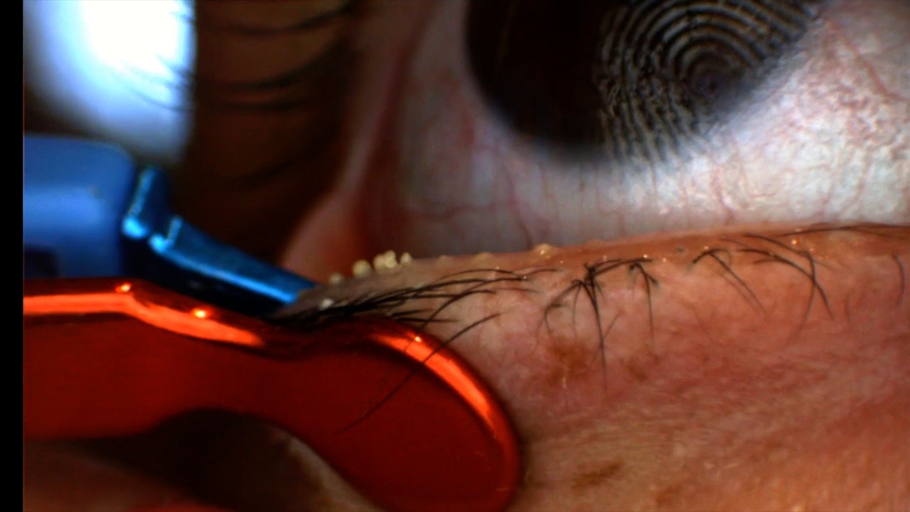 MGrx dry eye treatment video