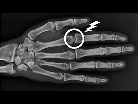 Carica per osteocondrosi vertebrale cervicale il video toracica Carica LFK della malattia degenerativa del disco cervicale