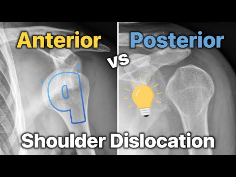 How To Diagnose Anterior vs Posterior Shoulder Dislocations!