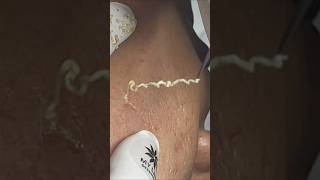 😱 A pimple as long as a finger! #shortvideo #skincare #satisfying #treatments #blackhead