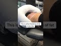 How We Freeze Fat With CoolSculpting Shorts