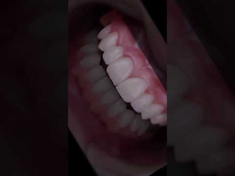 نتائج — إعادة تأهيل الفكين