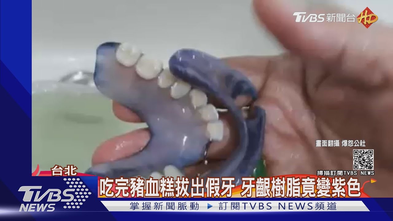 吃完豬血糕拔出假牙 牙齦樹脂竟變紫色