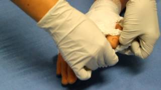 Evaluation/Treatment of the Child with a Burn Injury, Hand Burn Dressing