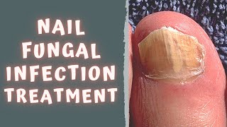 HOW TO TREAT FUNGAL NAIL INFECTION - TINEA UNGUIUM / ONYCHOMYCOSIS