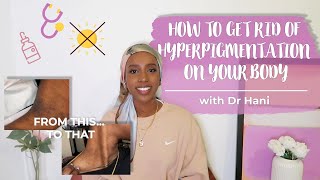 How To Fade Dark Marks On Your Body (fast!) | Dr Hani
