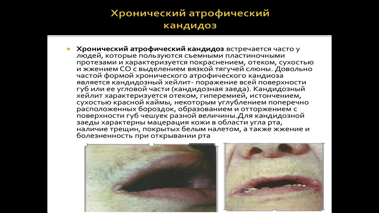 Бактериальные инфекции и их проявление на слизистой оболочке полости рта