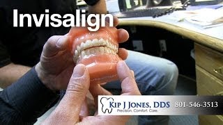 preview picture of video 'Invisalign Utah | Layton Dentist Kip J Jones, DDS | 801-546-3513'