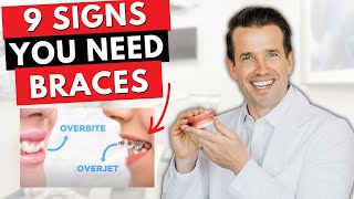 9 Signs you Need Braces | Overjet, overbite, crowding...