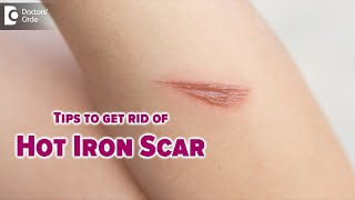 GET RID OF SCARS FROM BURNS | How do I remove a hot iron scar? - Dr. Nischal K | Doctors