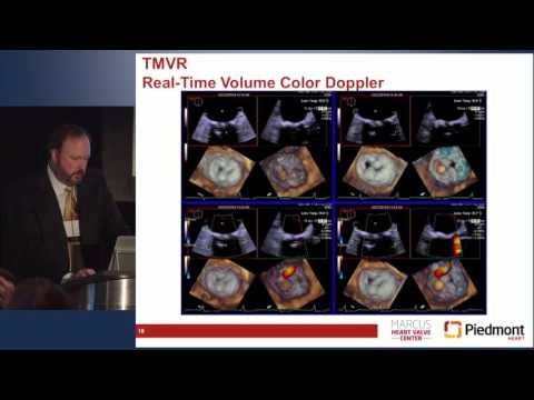 TMVR: A Journey with a Destination