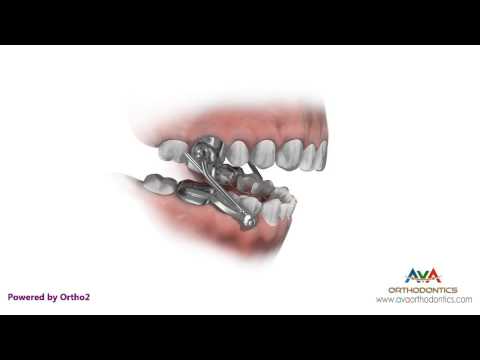 Orthodontics Treatment for Overjet (Overbite) - Herbst Appliance
