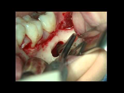 Surgical Removal of a Simple Bone Cyst from the Posterior Mandible