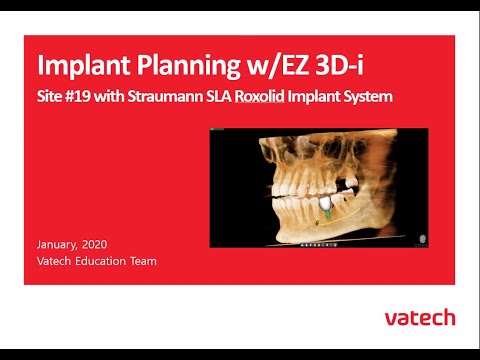 Site #19 with Straumann SLA Roxolid Implant System