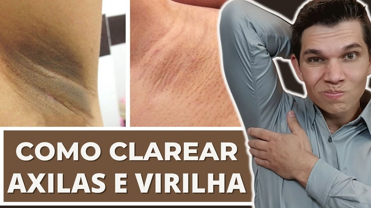 Watch Now Clareamento de Axila, Virilha, Cotovelo, Joelho - Receita Caseira passo a passo Clareamento de Axila, Virilha, Cotovelo, Joelho - Receita Caseira passo a passo