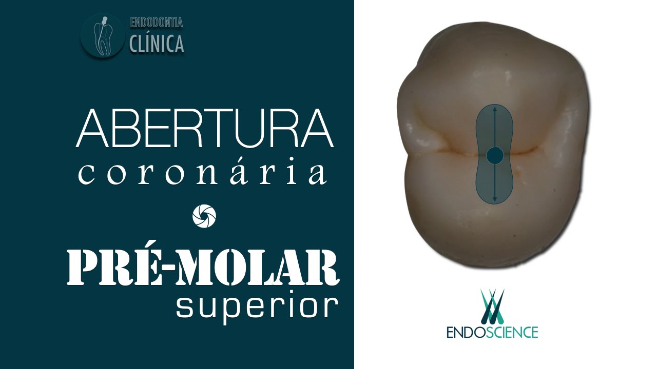 Anatomia e abertura coronária do Pré-Molar Superior