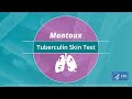 Mantoux Tuberculin Skin Test Video